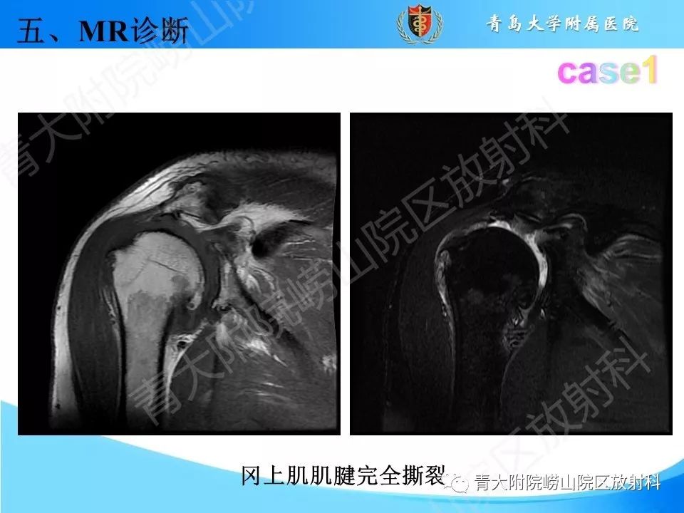 【PPT】肩关节运动损伤的MRI诊断