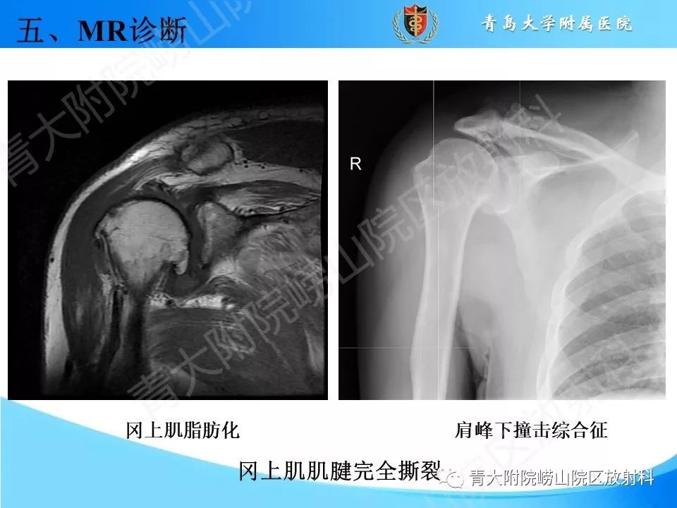 【PPT】肩关节运动损伤的MRI诊断