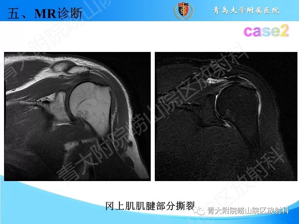 【PPT】肩关节运动损伤的MRI诊断