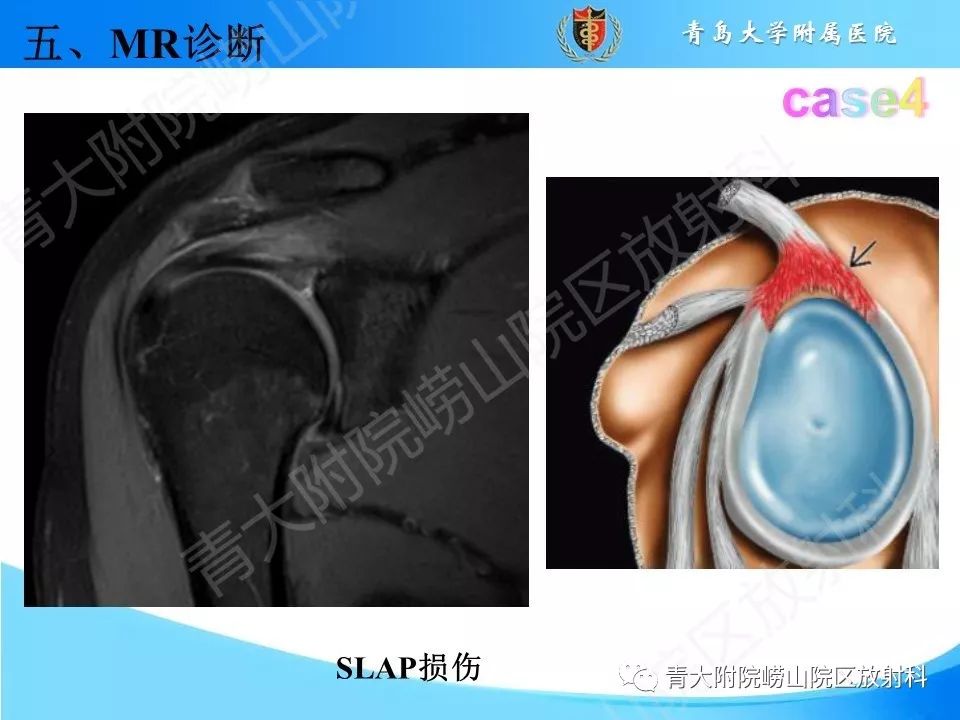 【PPT】肩关节运动损伤的MRI诊断