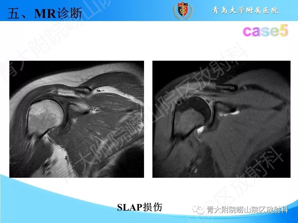 【PPT】肩关节运动损伤的MRI诊断