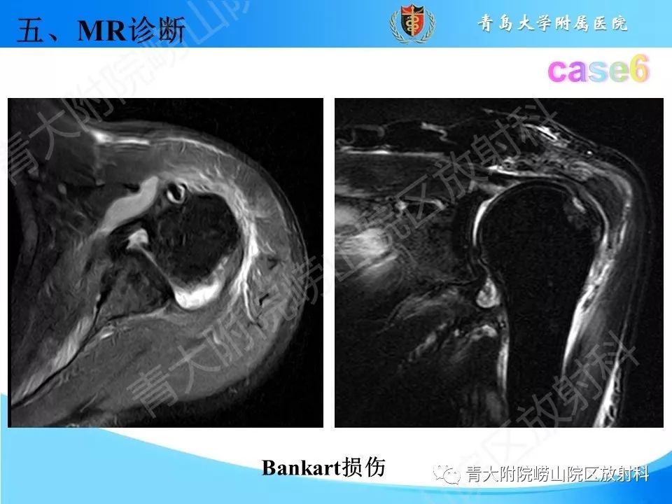 【PPT】肩关节运动损伤的MRI诊断