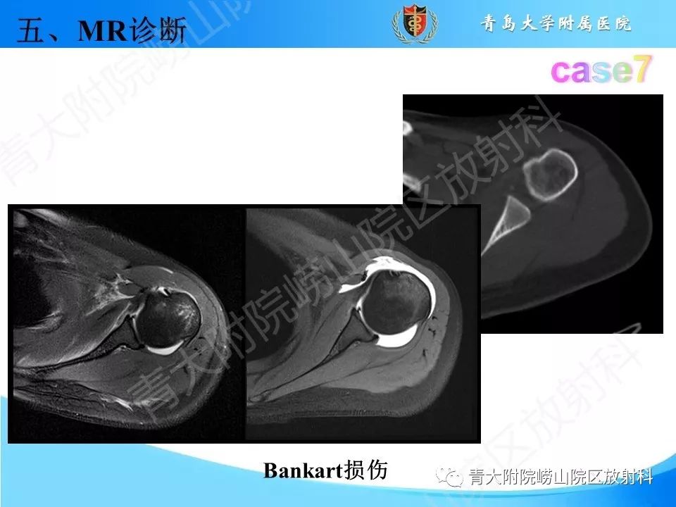 【PPT】肩关节运动损伤的MRI诊断