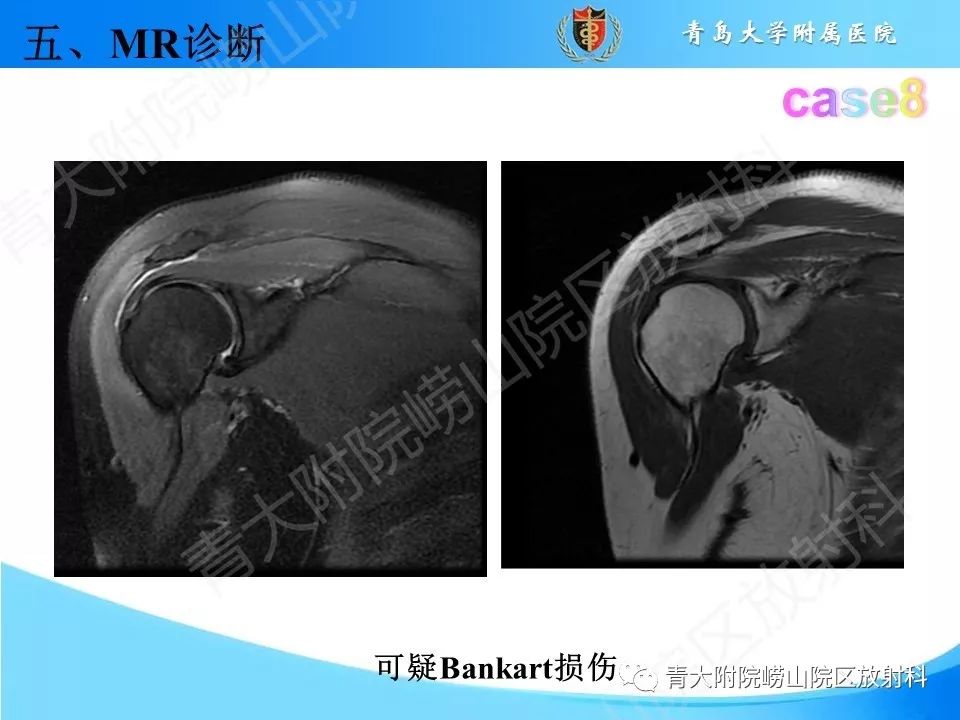 【PPT】肩关节运动损伤的MRI诊断