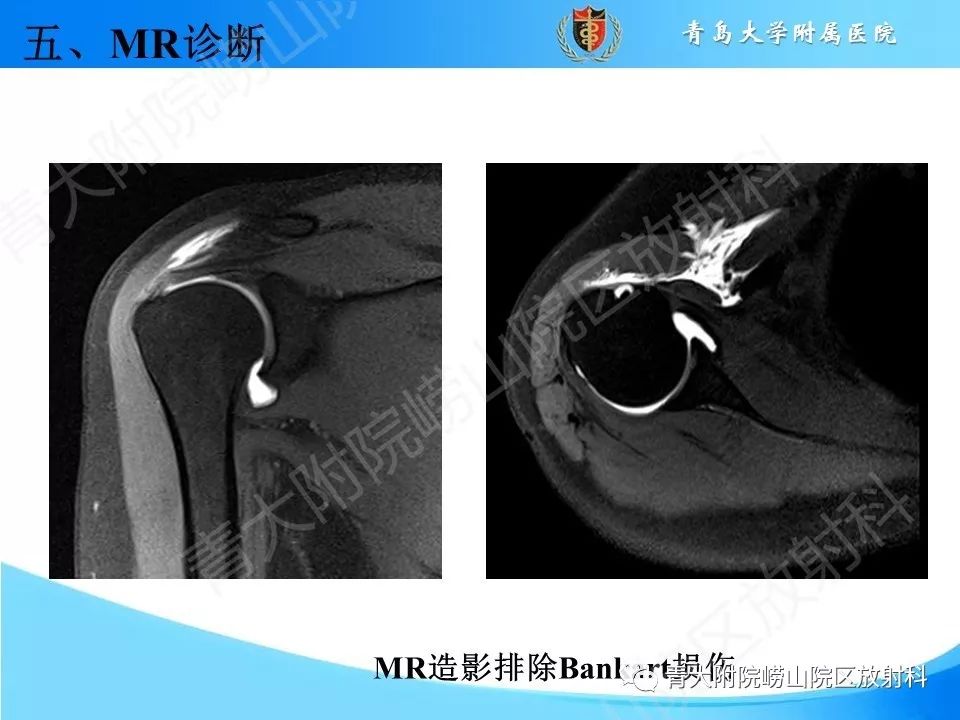 【PPT】肩关节运动损伤的MRI诊断