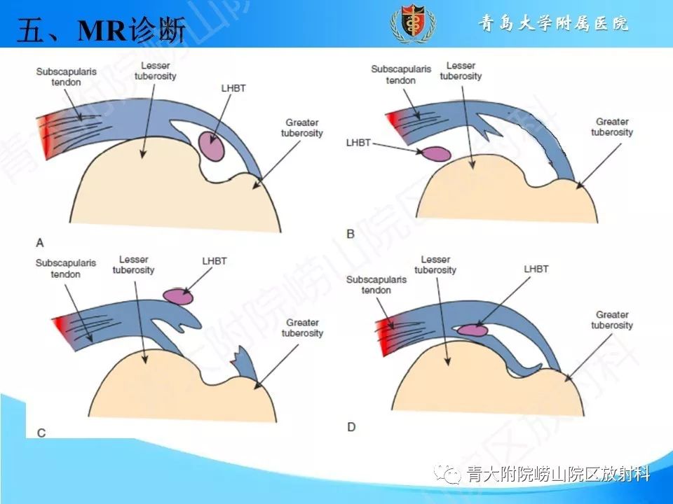 【PPT】肩关节运动损伤的MRI诊断