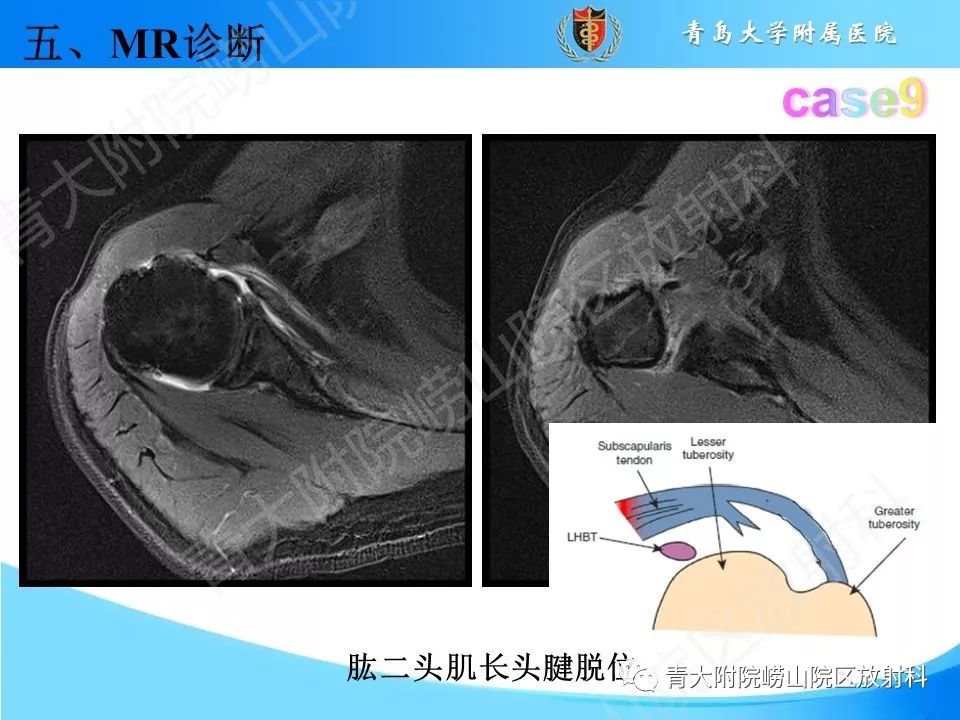 【PPT】肩关节运动损伤的MRI诊断