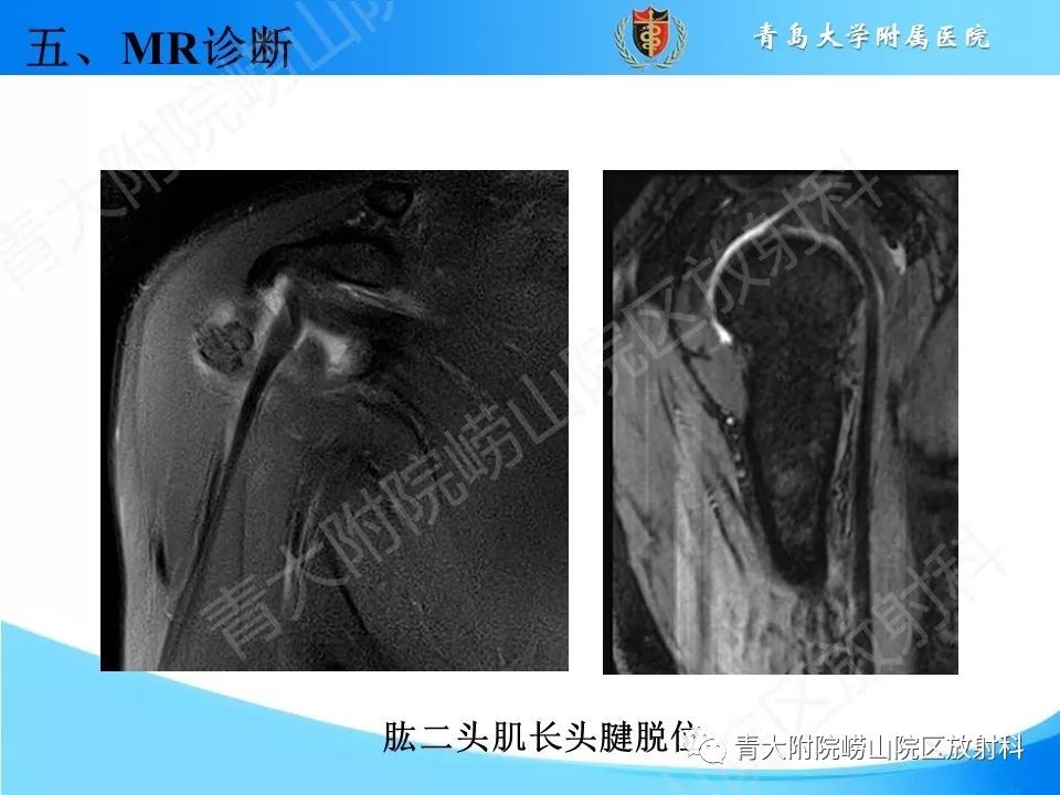 【PPT】肩关节运动损伤的MRI诊断