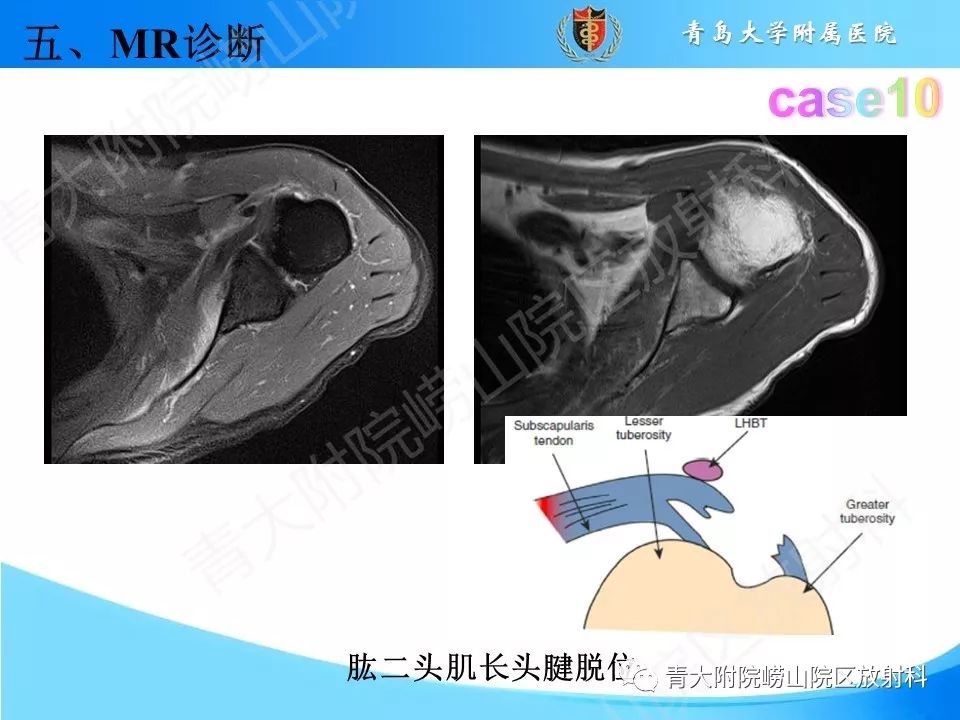 【PPT】肩关节运动损伤的MRI诊断