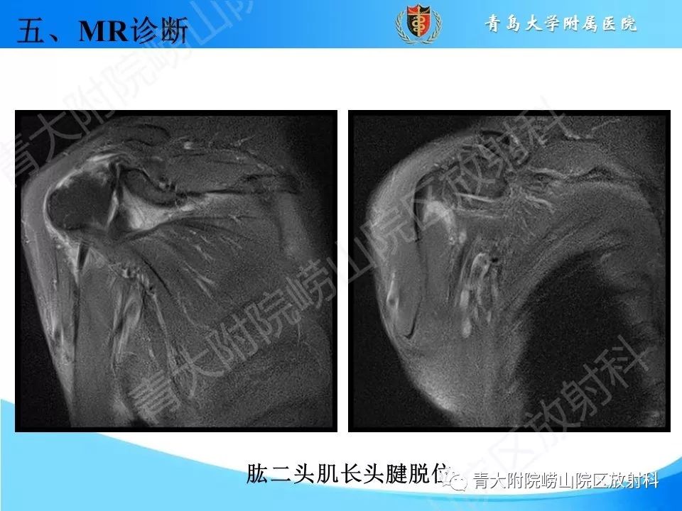 【PPT】肩关节运动损伤的MRI诊断