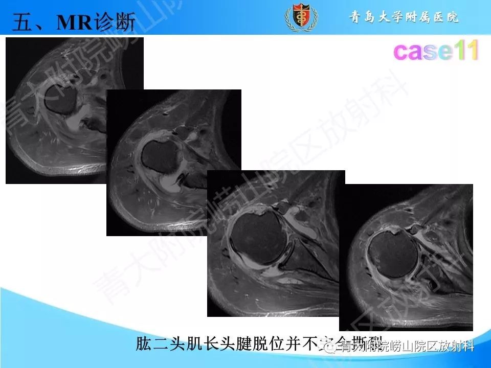 【PPT】肩关节运动损伤的MRI诊断