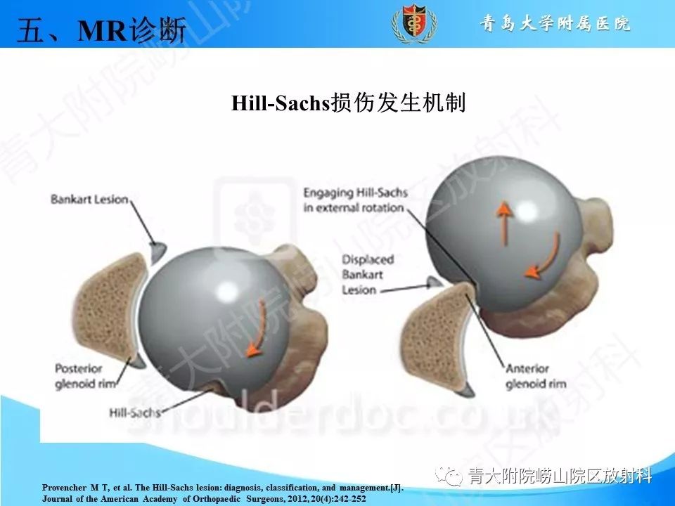 【PPT】肩关节运动损伤的MRI诊断