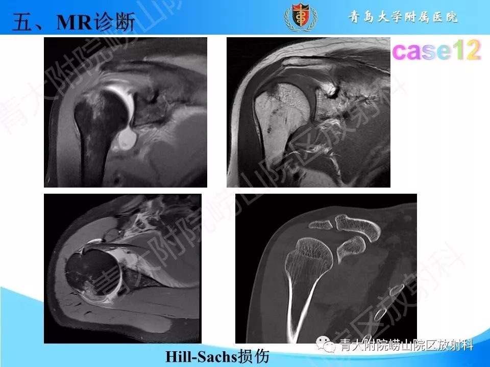 【PPT】肩关节运动损伤的MRI诊断