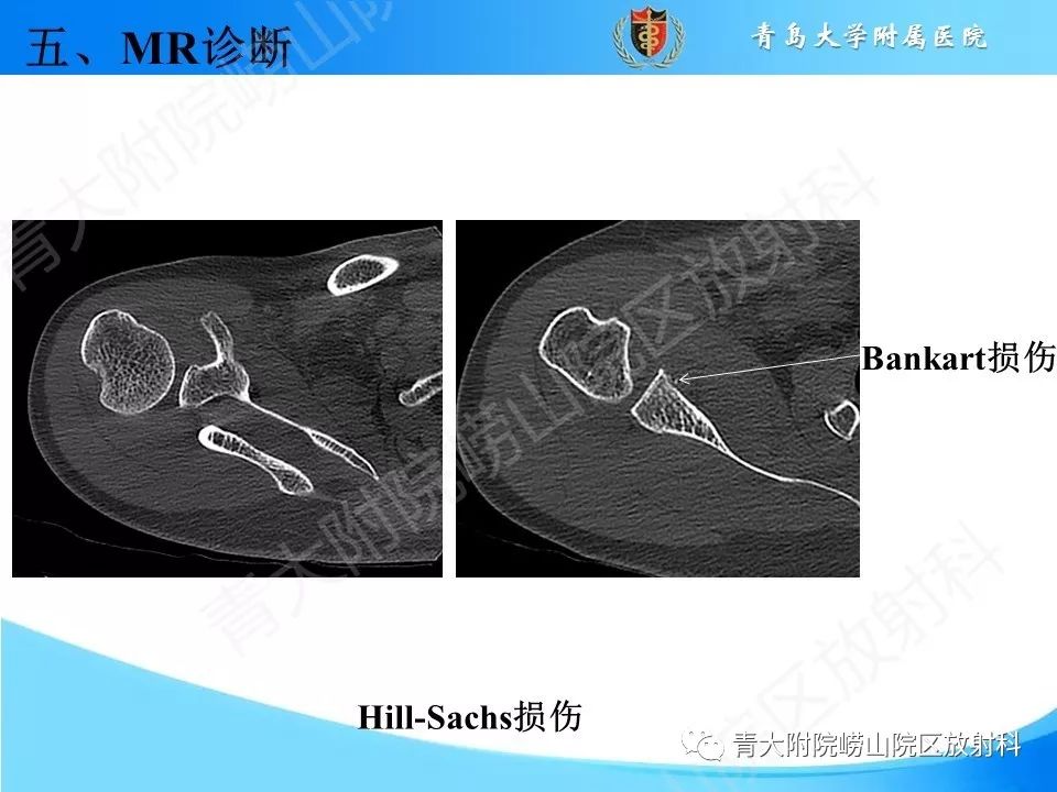 【PPT】肩关节运动损伤的MRI诊断