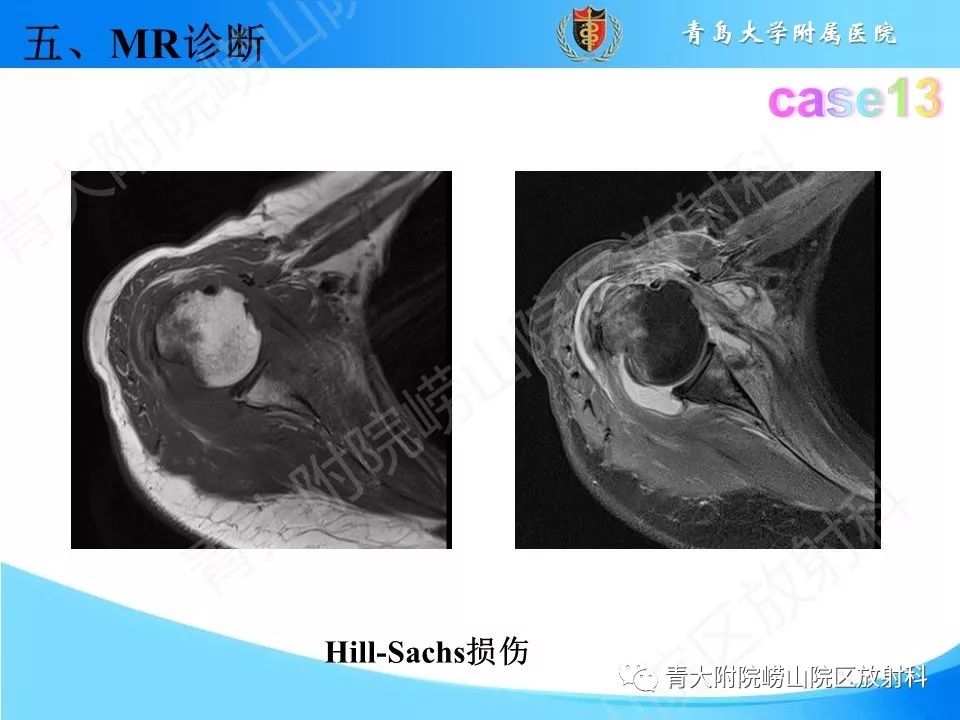 【PPT】肩关节运动损伤的MRI诊断