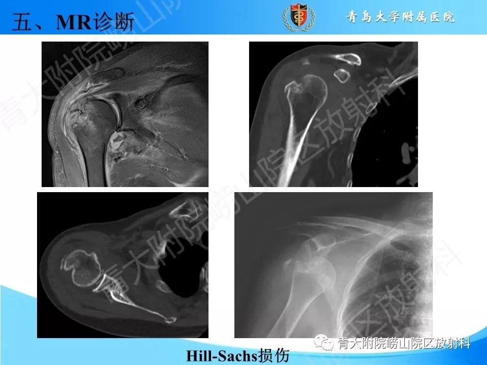 【PPT】肩关节运动损伤的MRI诊断