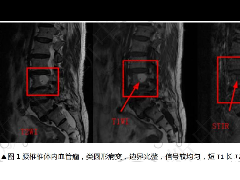 椎体血管瘤影像学诊断