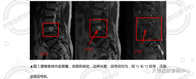 椎体血管瘤影像学诊断-2 椎体血管瘤影像学诊断-2