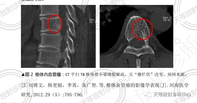 椎体血管瘤影像学诊断-3 椎体血管瘤影像学诊断-3