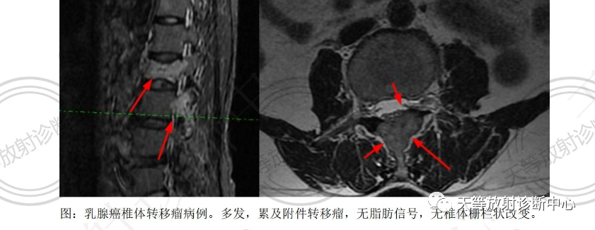椎体血管瘤影像学诊断-5 椎体血管瘤影像学诊断-5