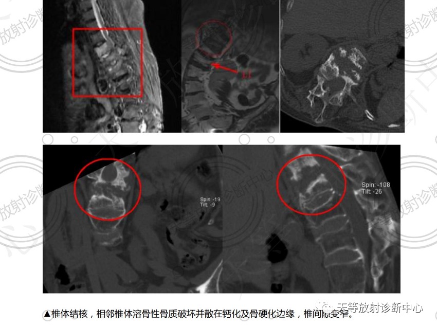 椎体血管瘤影像学诊断-6 椎体血管瘤影像学诊断-6