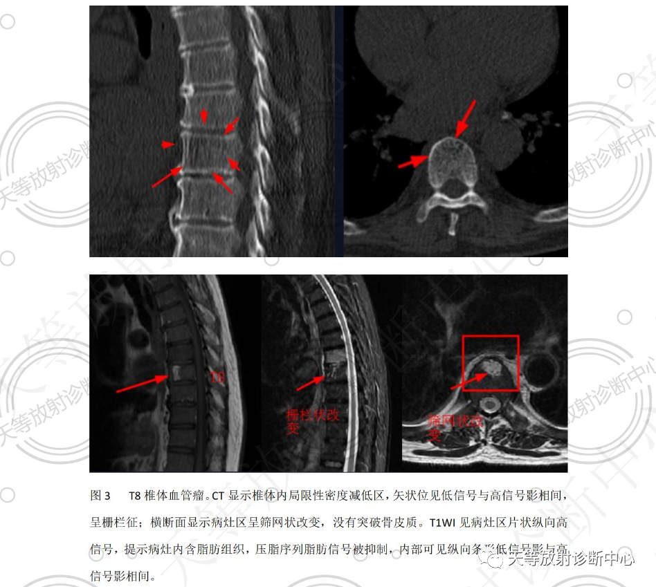 椎体血管瘤影像学诊断-4 椎体血管瘤影像学诊断-4