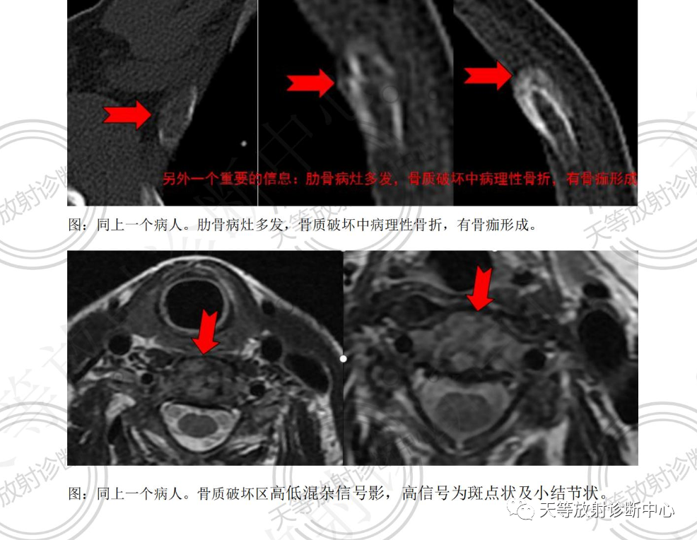 椎体血管瘤影像学诊断-8 椎体血管瘤影像学诊断-8
