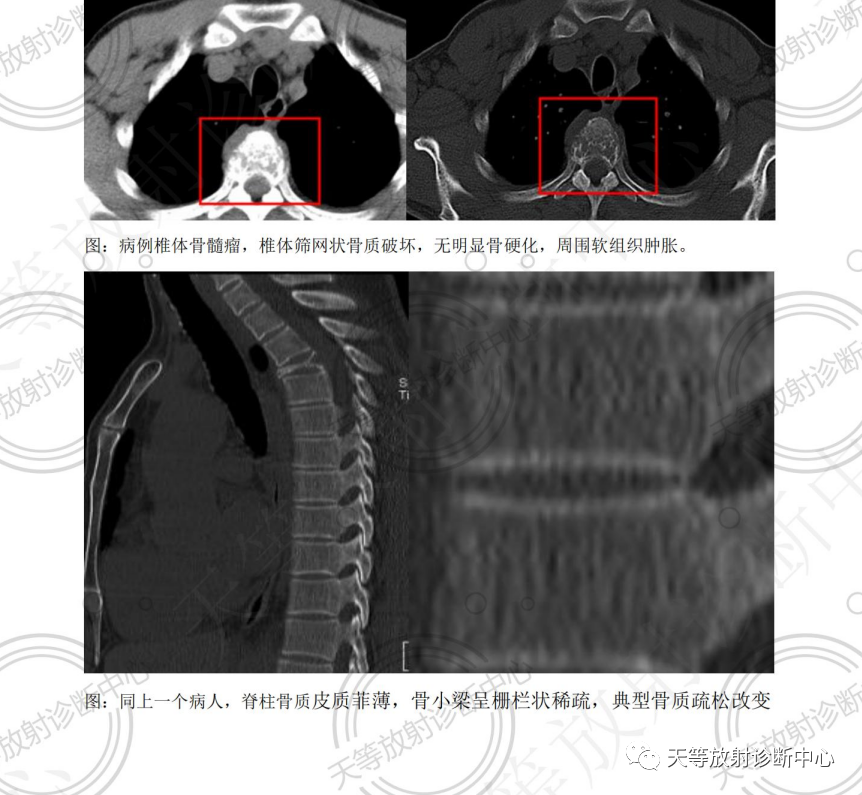 椎体血管瘤影像学诊断-7 椎体血管瘤影像学诊断-7