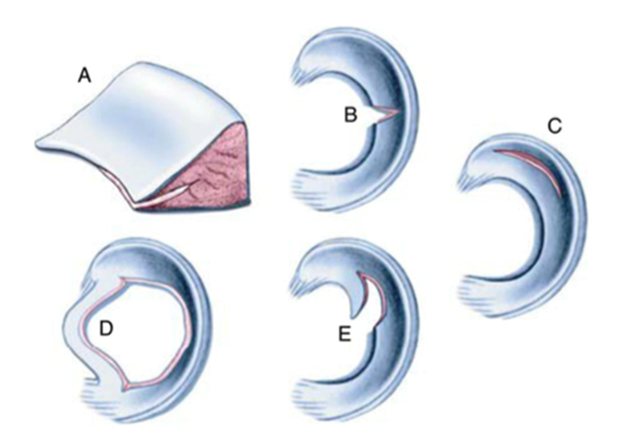 半月板解剖分区和损伤分类-2
