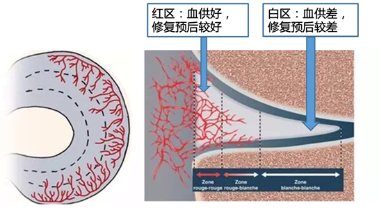 半月板解剖分区和损伤分类-1