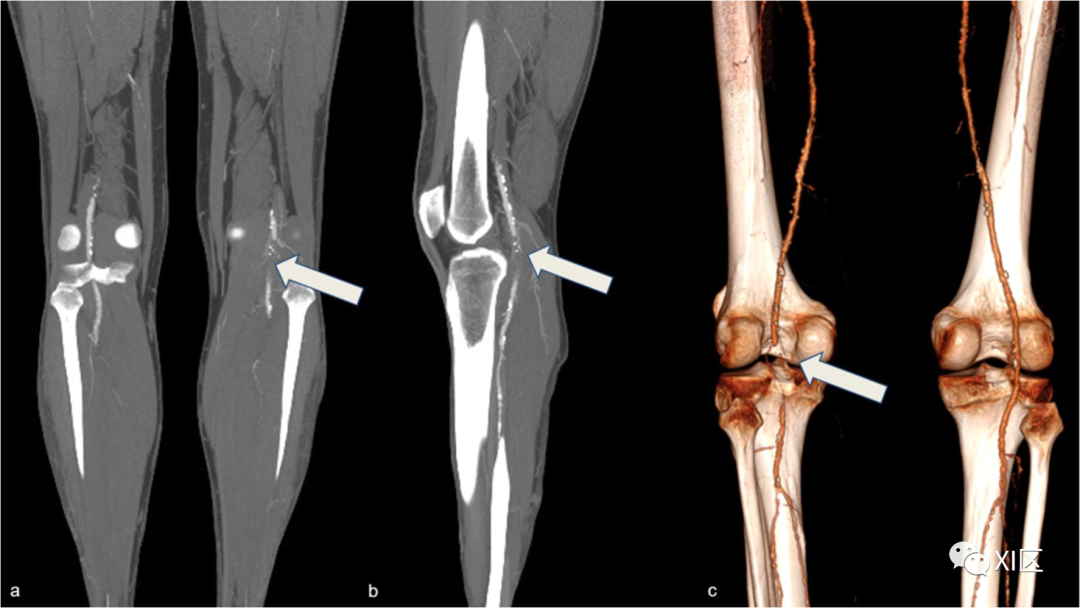 下肢CTA—从解剖学到创伤性和非创伤性病变-5