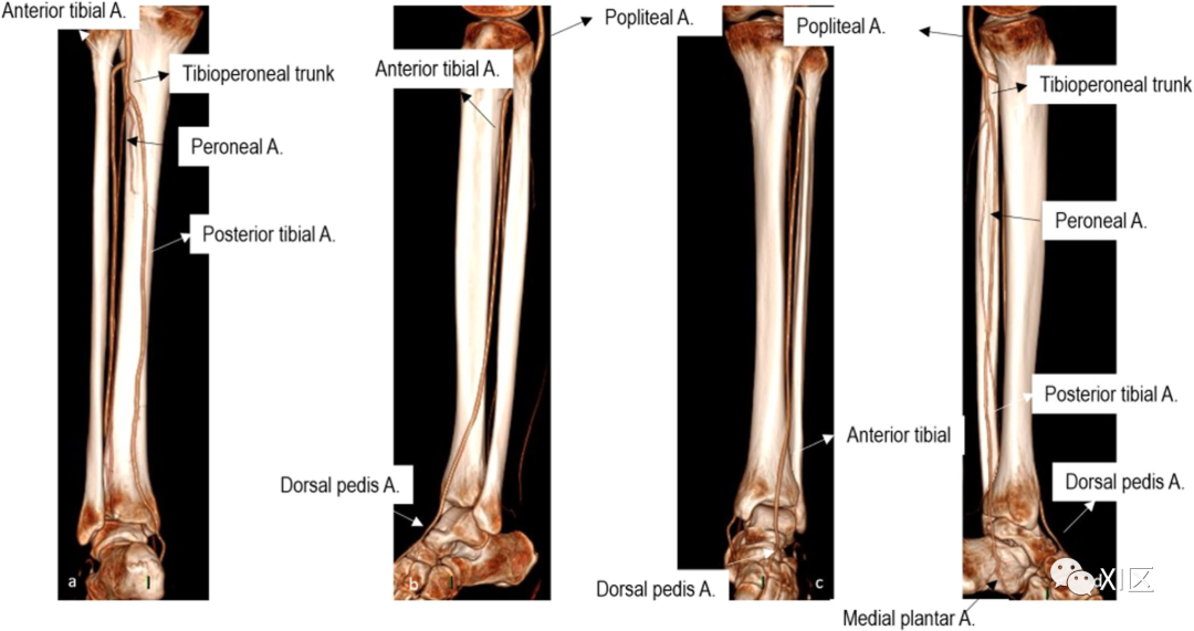 下肢CTA—从解剖学到创伤性和非创伤性病变-3