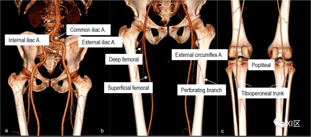 下肢CTA—从解剖学到创伤性和非创伤性病变-2