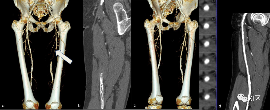 下肢CTA—从解剖学到创伤性和非创伤性病变-4
