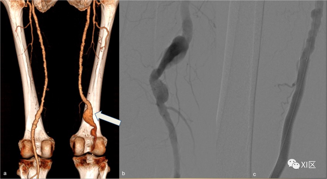 下肢CTA—从解剖学到创伤性和非创伤性病变-6