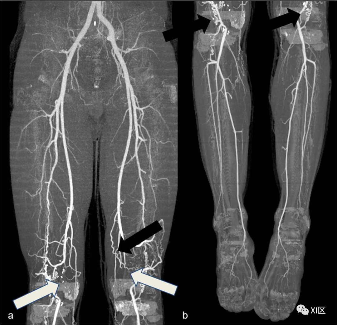 下肢CTA—从解剖学到创伤性和非创伤性病变-8