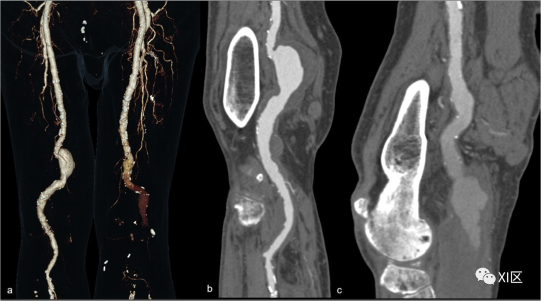 下肢CTA—从解剖学到创伤性和非创伤性病变-7