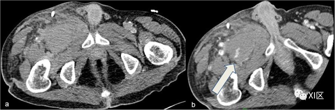下肢CTA—从解剖学到创伤性和非创伤性病变-10
