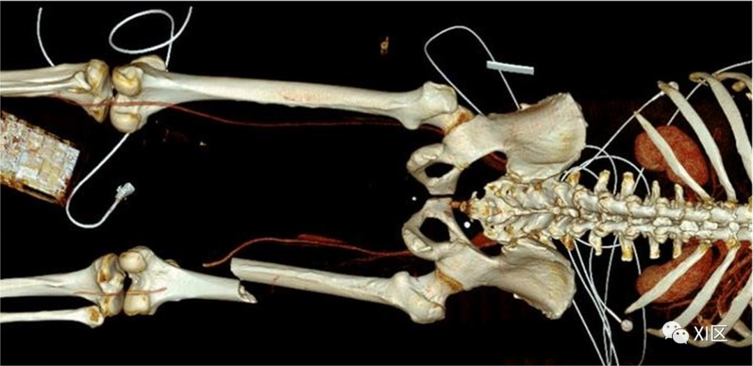 下肢CTA—从解剖学到创伤性和非创伤性病变-11