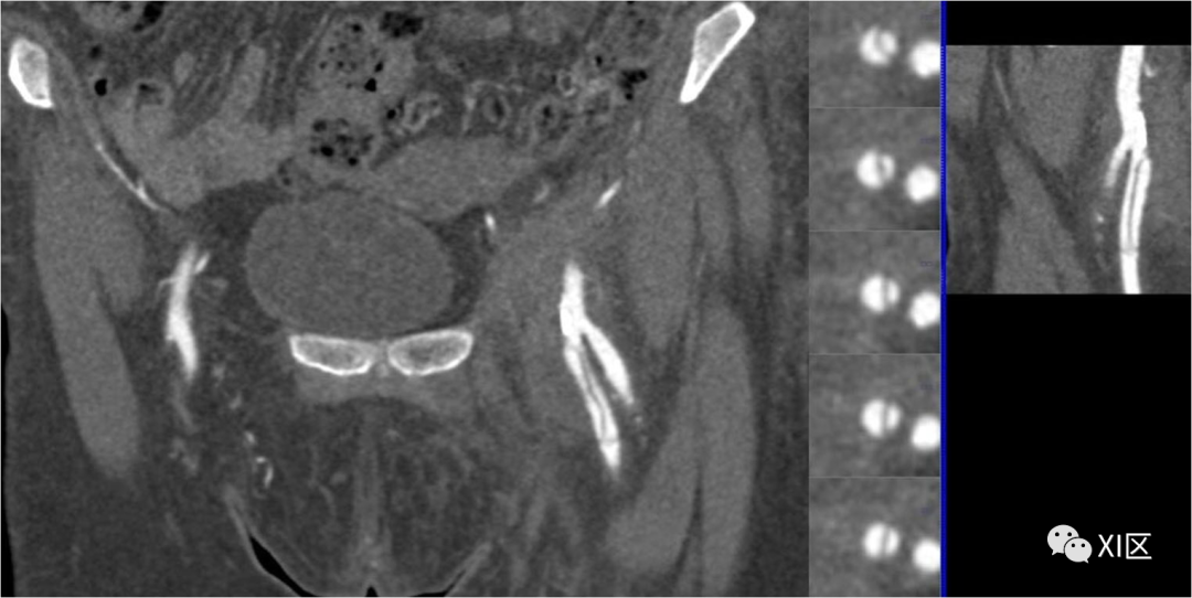 下肢CTA—从解剖学到创伤性和非创伤性病变-12