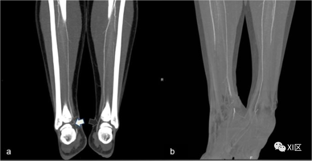 下肢CTA—从解剖学到创伤性和非创伤性病变-13
