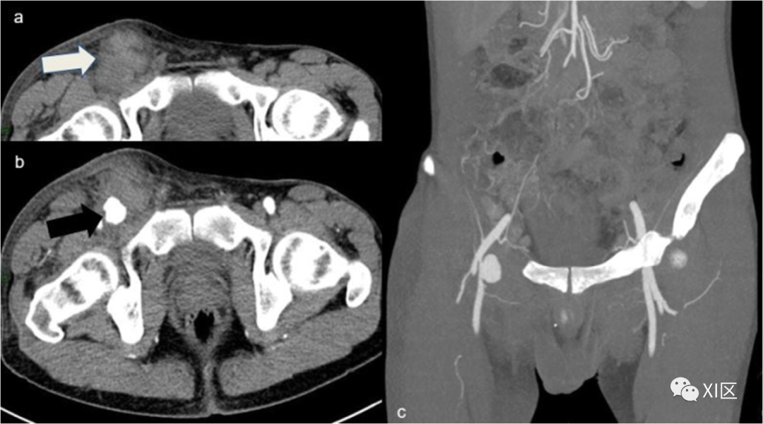 下肢CTA—从解剖学到创伤性和非创伤性病变-14