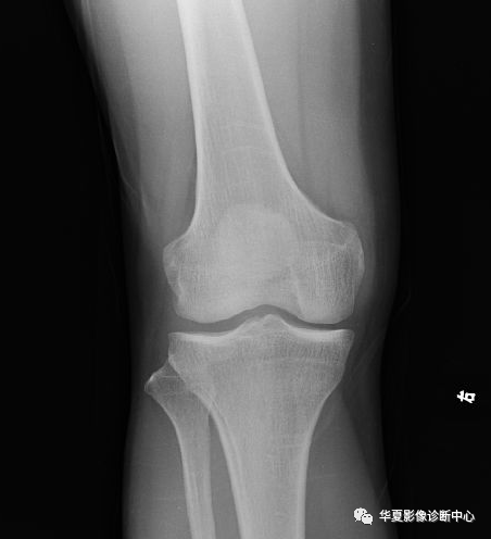 隐性骨折（骨挫伤）影像表现-1