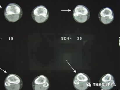 隐性骨折（骨挫伤）影像表现-2
