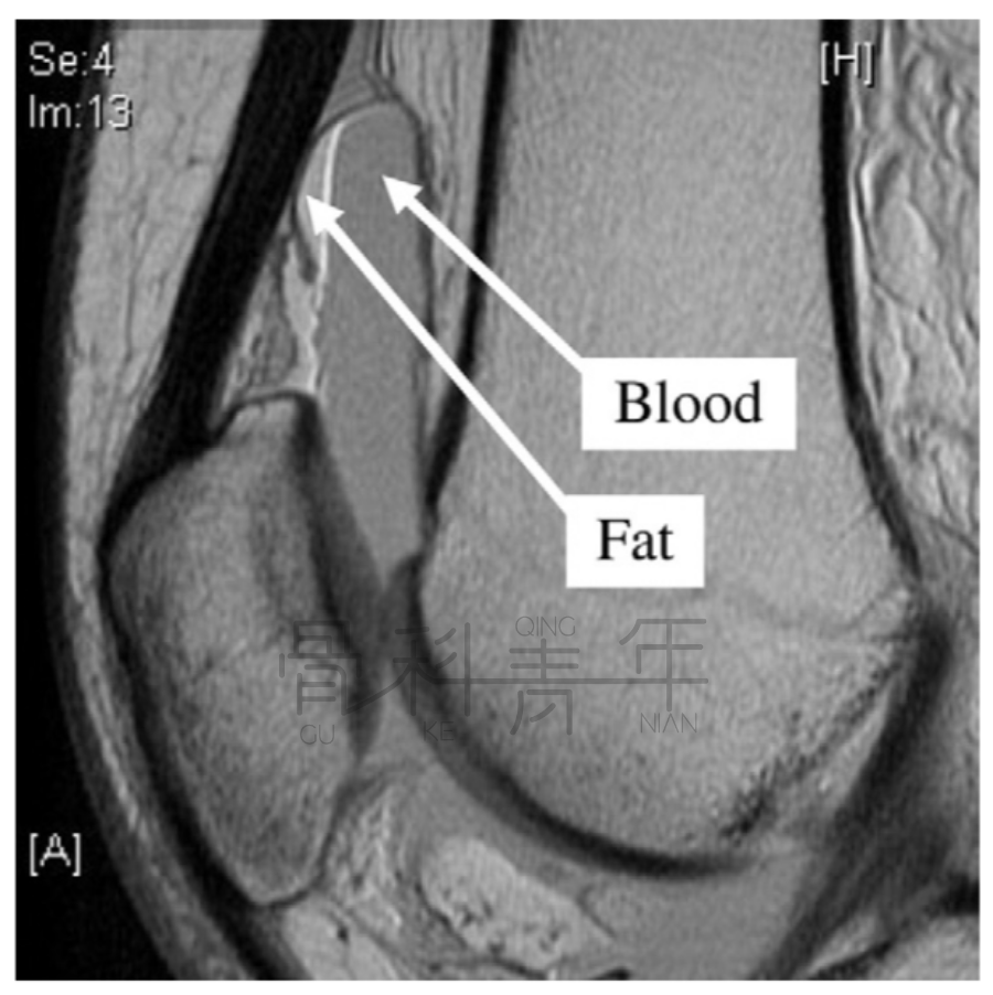 关节积脂血症(lipohemarthrosis)-2