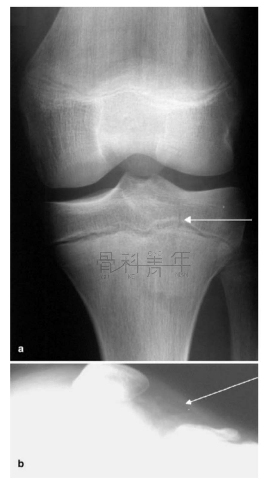 关节积脂血症(lipohemarthrosis)-3