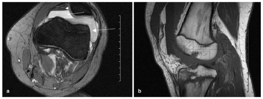 关节积脂血症(lipohemarthrosis)-4