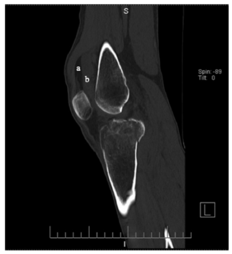 关节积脂血症(lipohemarthrosis)-7