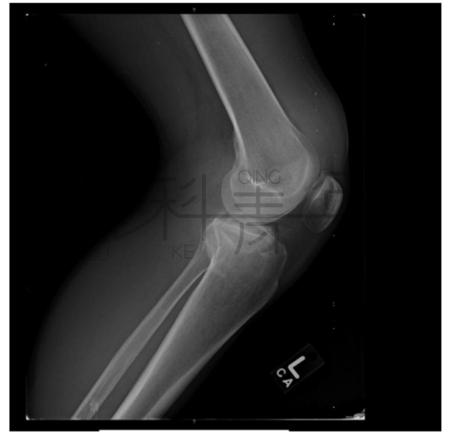 关节积脂血症(lipohemarthrosis)-5