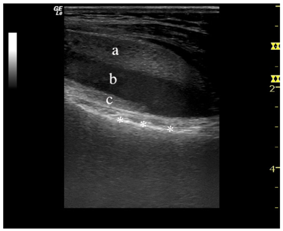 关节积脂血症(lipohemarthrosis)-6